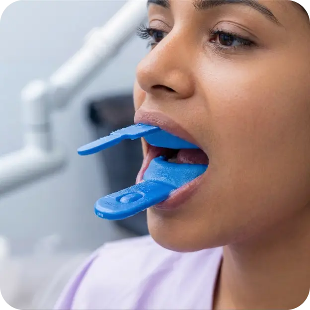 Fluoride Application